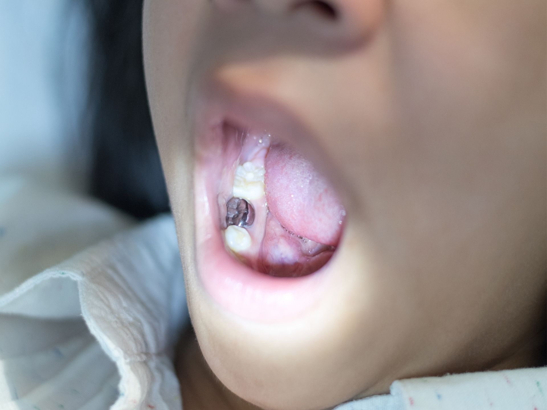 Alternatywne formy zabezpieczenia zęba, który kwalifikuje się do leczenia amalgamatycznego.
